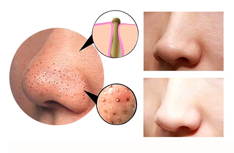 4 in 1 Body Guasha Cupping Blackhead Remover Facial Pore